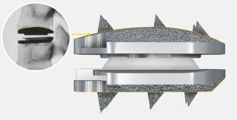 What is Cervical Disc Arthroplasty?