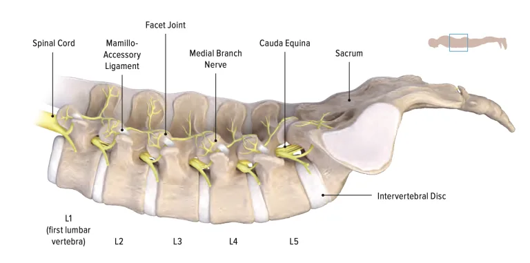 Medial Branch Transection for Facet Arthritis