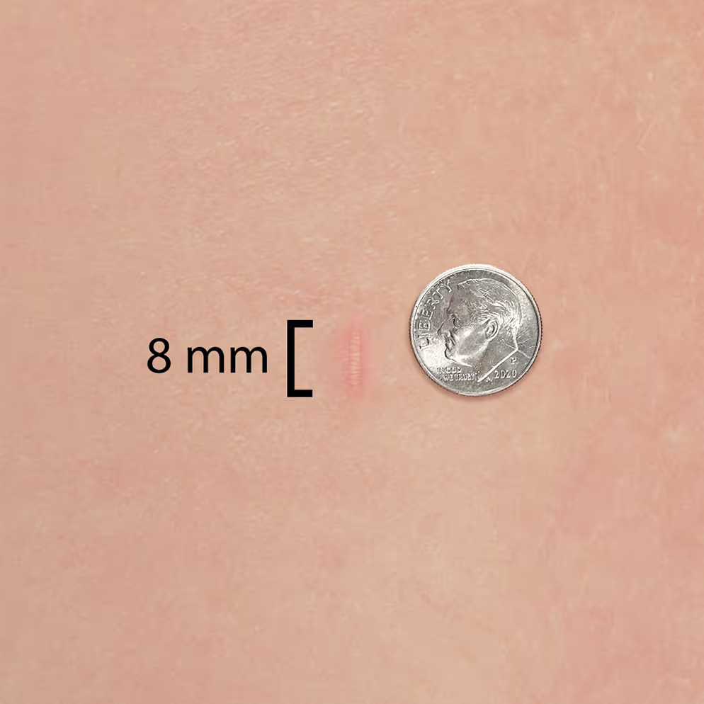 Healed 8 mm endoscopic spine incision next to a U.S. dime for scale