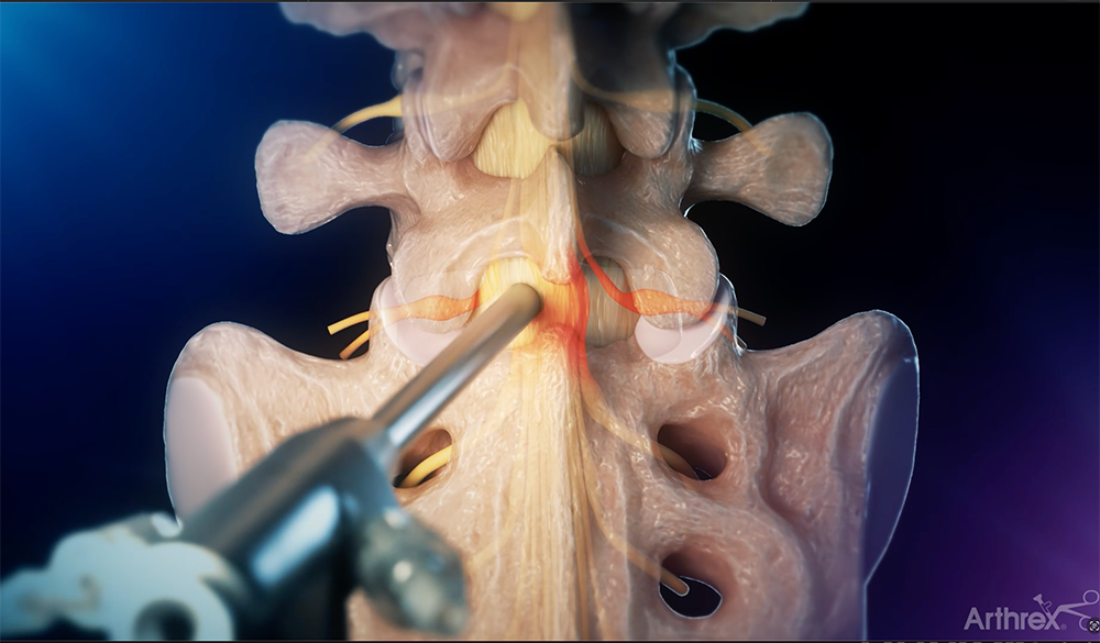 Illustration of endoscope accessing an L5–S1 disc herniation via the interlaminar approach