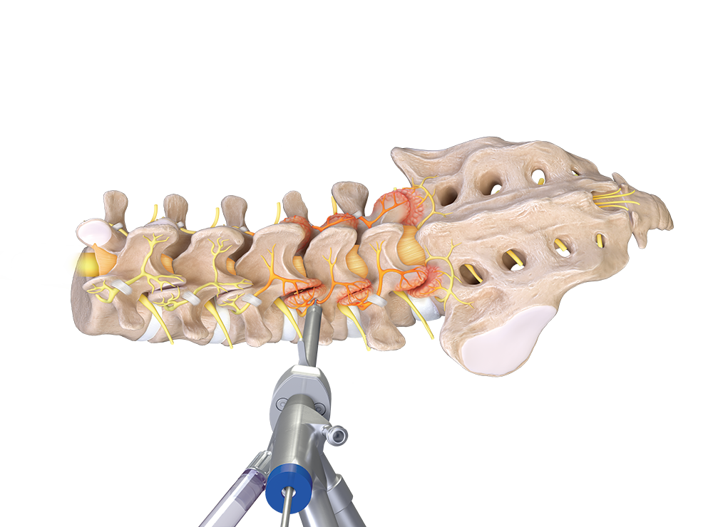 Illustration of endoscope positioned for medial branch nerve transection at the lumbar facet
