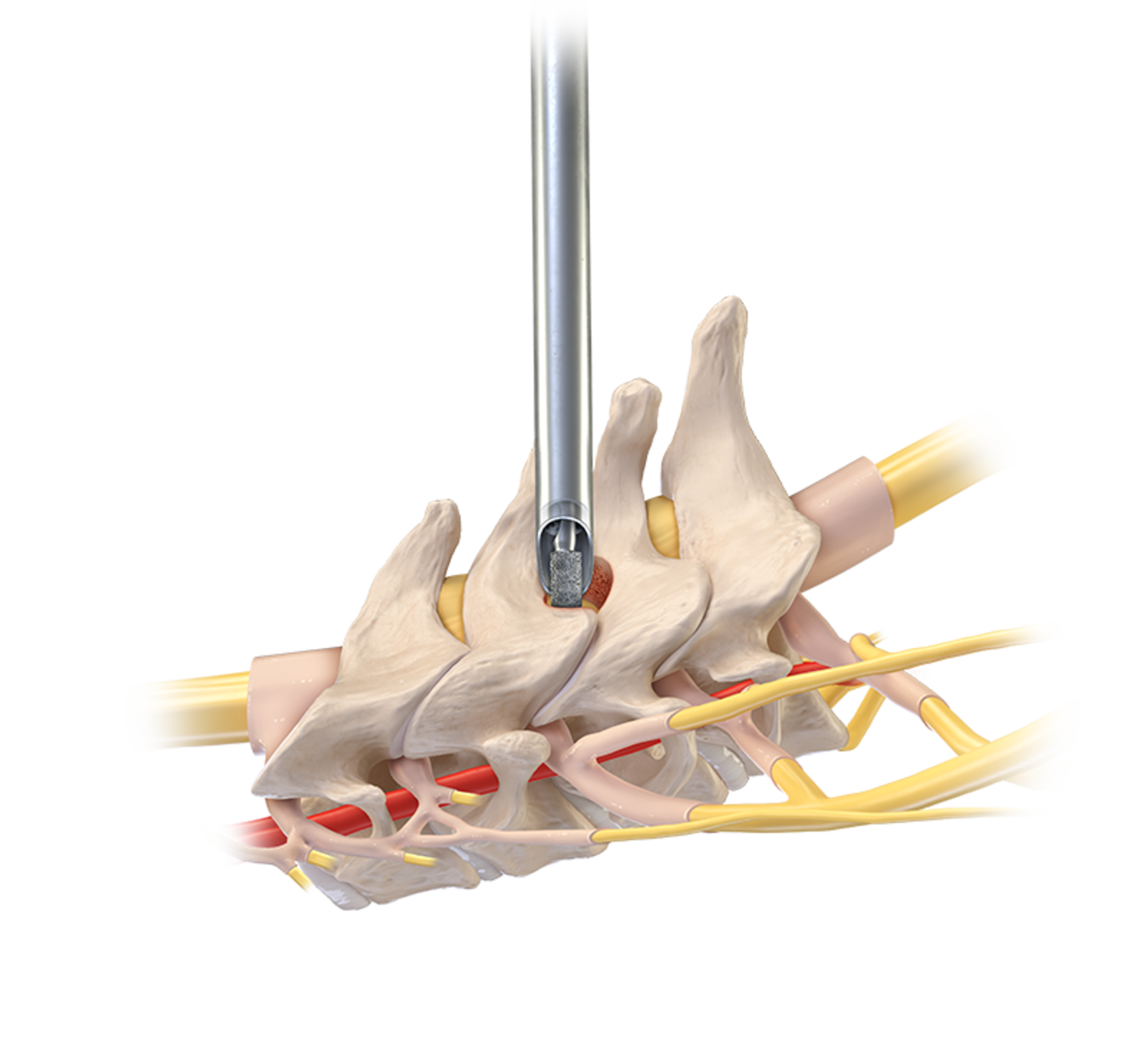 Illustration of endoscope performing a posterior cervical foraminotomy to decompress a cervical nerve root