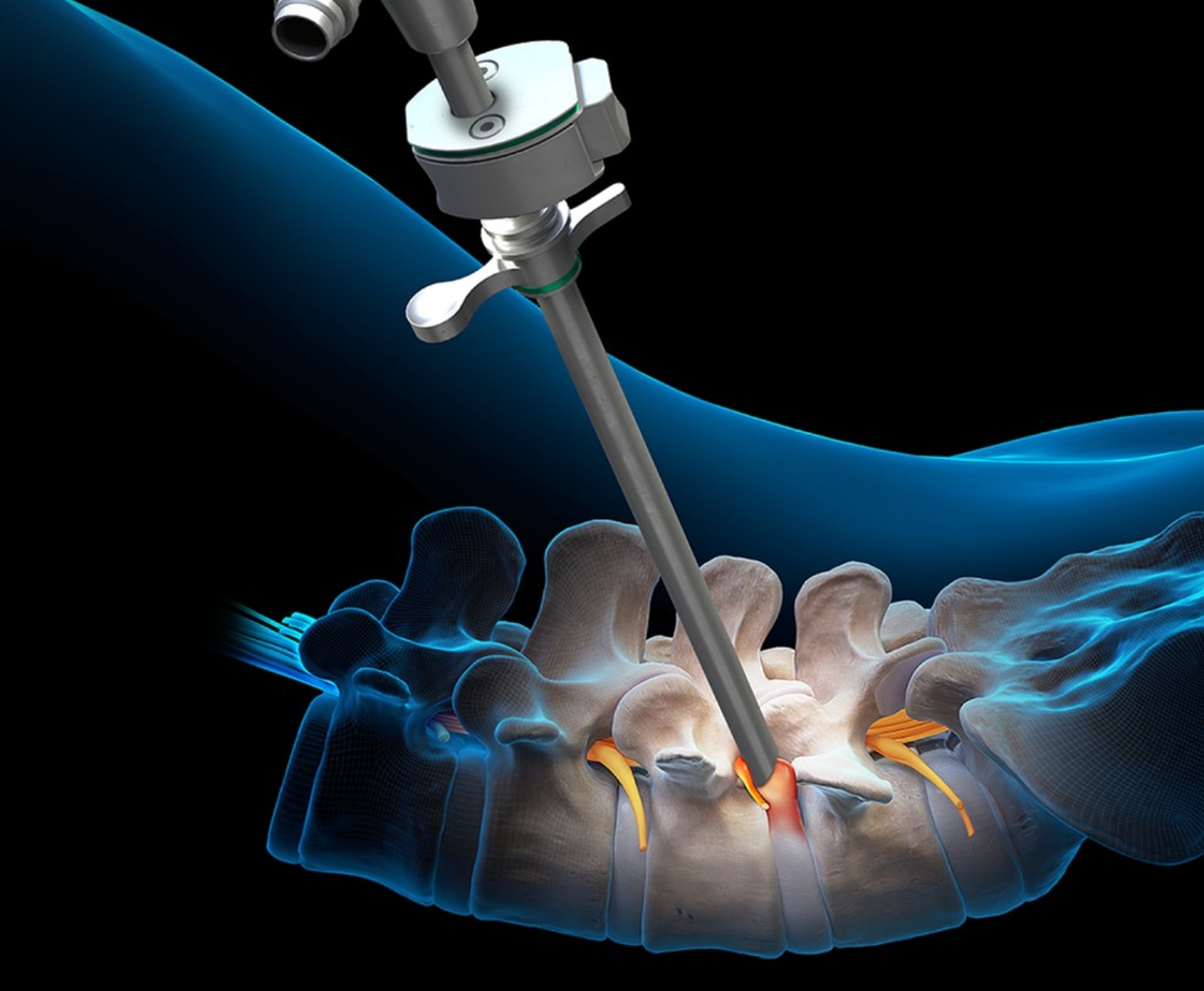 Illustration of endoscope accessing the spine through a transforaminal approach with highlighted nerve target
